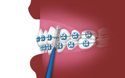 interdental.png